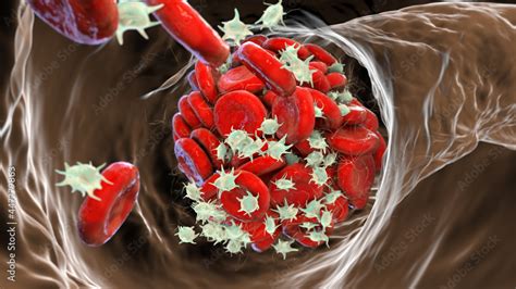 Blood Clot Made Of Red Blood Cells Platelets And Fibrin Protein