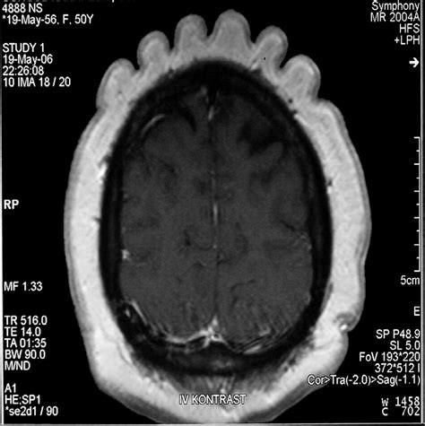 An Unusual Association Of Cutis Verticis Gyrata With Empty Sella