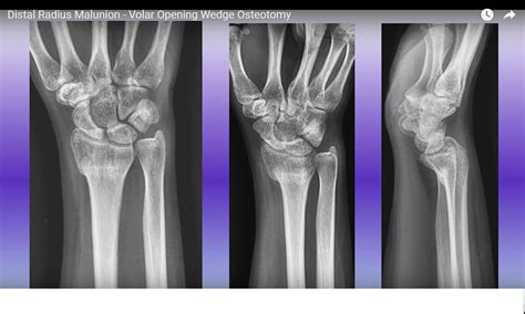 Volar Opening Wedge Osteotomy for Distal Radius Malunion ...