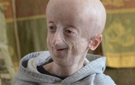 Progeria Syndrome Types Causes And Symptoms Healthtian