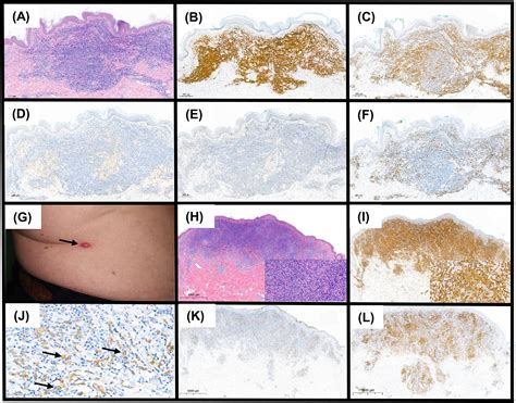 Primary Cutaneous Lymphoproliferations In The Gray Zone Between Marginal Zone Lymphoma And Cd4