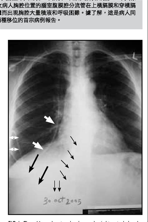 Figure 1 From Supradiaphragmatic And Transdiaphragmatic Intrathoracic