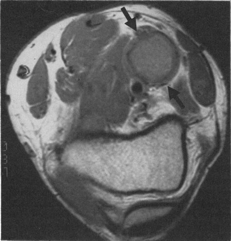 Case 49 1991 A 46 Year Old Man With A Mass In The Popliteal Fossa NEJM