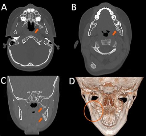 Fibrodysplasia Ossificans Progressiva: A Case Report with Pseudo