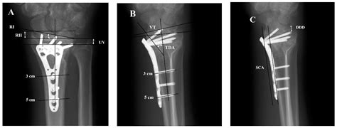 Jcm Free Full Text Radiographic Analysis In Extra Articular And