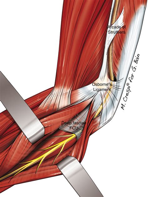 Endoscopic Cubital Tunnel Decompression Review Of The Literature