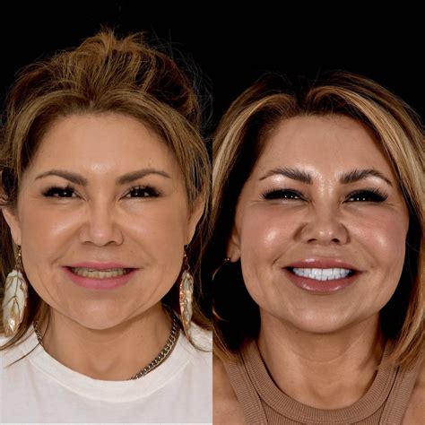 Gallery Before And After Dental Veneers In Los Angeles Ca Smiles By