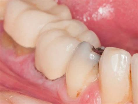 Qu Son Las Caries Dentales Tratamientos Y Causas Dentista Talavera