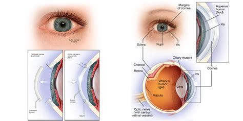 Cornea Transplant Lasik Turkey