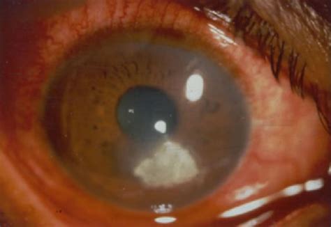 Corneal Ulcer Contact Lens