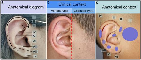 Anatomical Diagram Of Auricle And Classification Of Auricular Fistula Download Scientific