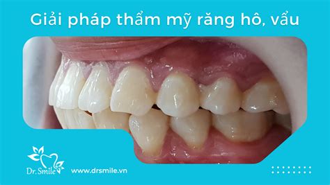 boc su cho rang ho  nen hay khong quy trinh ra sao