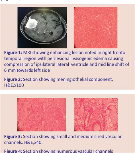 Figure From Angiomatous Meningioma A Rare Variant Semantic Scholar