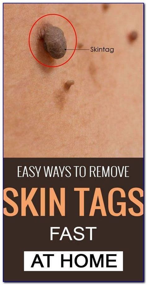 How To Remove Skin Tag In 1 Night