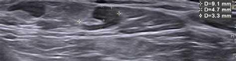 Left Supraclavicular Lymph Node With Preserved Fatty Hilus And