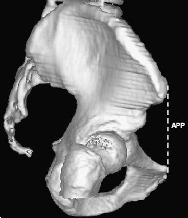 Oblique View Of A Pelvic CT 3D Reconstruction Obtained By Aligning The