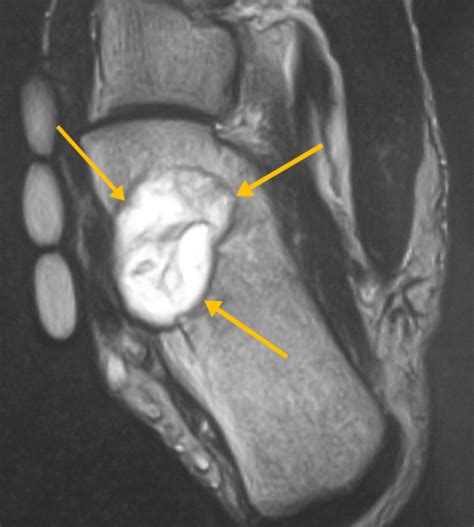 Chondromyxoid Fibroma