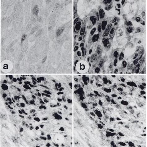 Photomicrographs Of Two Tumor Nodules In An Adenocarcinoma Two Tumors