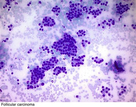 Pathology Outlines - Follicular carcinoma