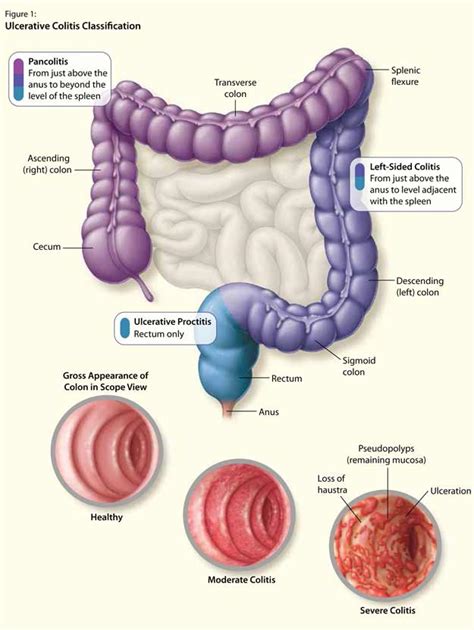 The Patient With Newly Diagnosed Ulcerative Colitis