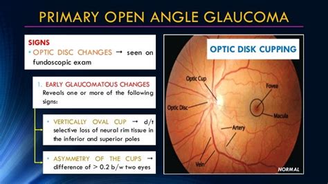 Primary Glaucoma