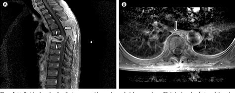 Figure From A Case Of Vertebral Osteomyelitis And Spinal Epidural