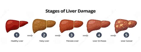 Pas Des Dommages Au Foie De Sain Fibrose Stéatose Hépatique Cirrhose Le Cancer Du Foie