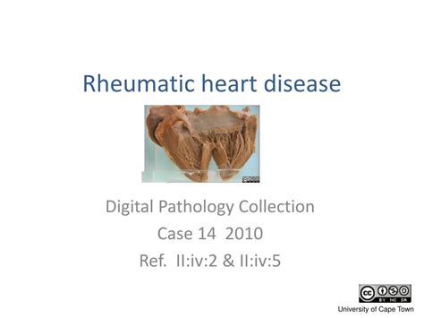 Ppt Rheumatic Heart Disease Powerpoint Presentation Free Download Id 5663159