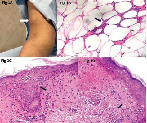 Figure From Panniculitis As The Transformed Cutaneous Manifestation