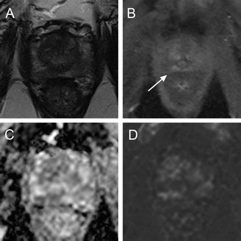 Impact Of Dynamic Contrast Enhanced Mri In 1 5 T Versus 3 T Mri For