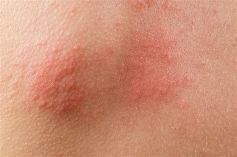 12 Common Signs Of Early Shingles You Shouldnt Ignore List