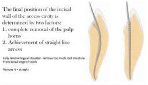 Endodontics Tooth Morphology In Endodontics The Importance Of