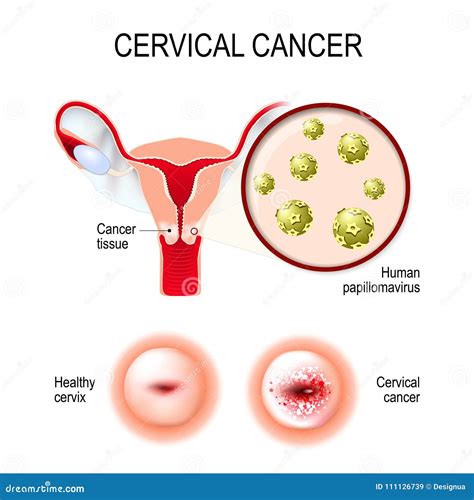 Hpv Cervical Cancer Treatment