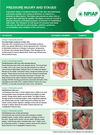 Pressure Ulcer Staging Guide