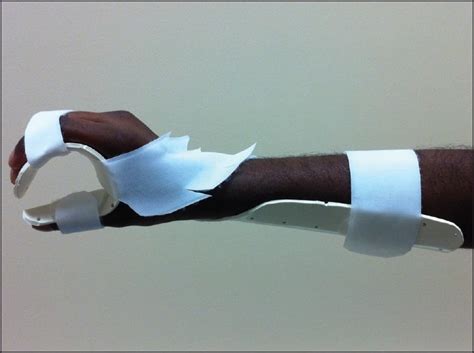 Custom-made dorsal forearm-based wrist splint | Download Scientific Diagram