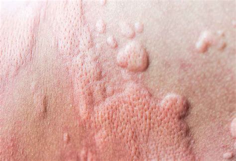 Puppp Rash During Pregnancy Causes Symptoms And Treatments