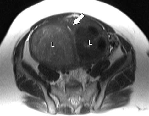 Role Of Mr Imaging Of Uterine Leiomyomas Before And After Embolization