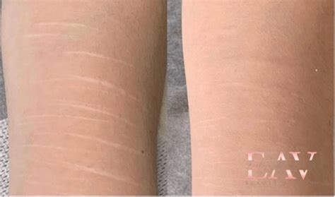 Camouflage Tattoo Stretch Marks Vitiligo Scars In Vaughan