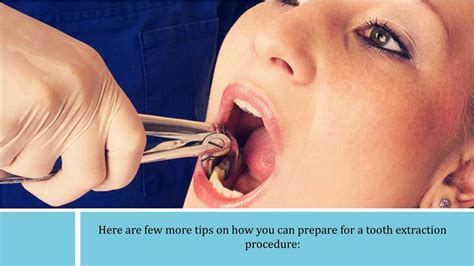 Ppt Tips On How To Prepare For A Tooth Extraction Procedure Powerpoint Presentation Id 7333265