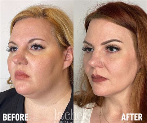 Weight Loss In Face Only At Betty Hochstetler Blog