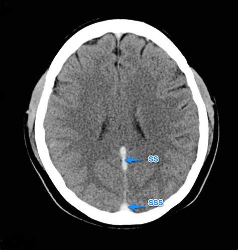 Inferior Sagittal Sinus Thrombosis