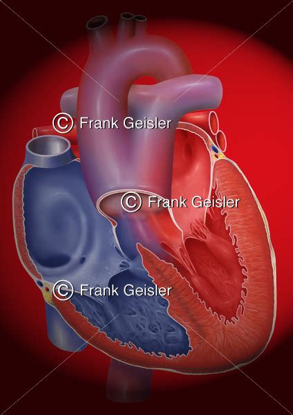 Notfallmedizin Herz Mit Truncus Arteriosus Communis Tac Medical