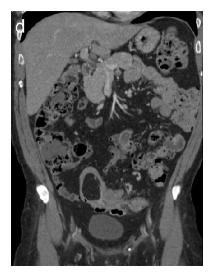 Colocolonic Sigmoid Intussusception Caused By A Lipoma Ultrasound Download Scientific