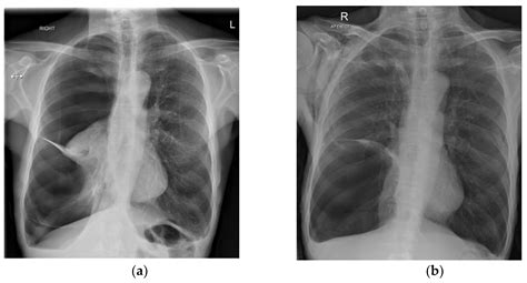 Jcm Free Full Text Management Of The Secondary Spontaneous