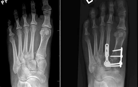 Injury Pictures Lisfranc Injury Pictures