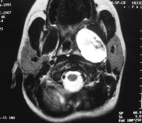 Preoperative MRI shows the parapharyngeal mass obliterating the ...