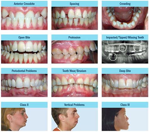 Common Orthodontic Problems Bordentown Braces