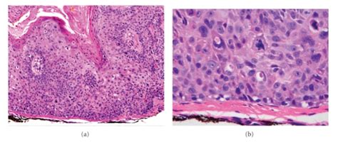 Squamous Cell Carcinoma In Situ SCCS Bowen S Disease A There Is