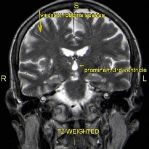 The Best Portland 3T MRI | Dizziness and Balance Problems: 3T MRI Brain