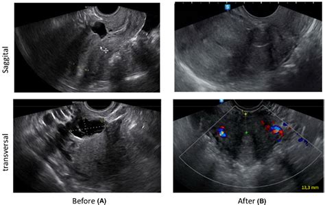 Reproductive Outcomes After Laparoscopic Resection Of Symptomatic